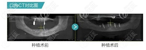 種植牙前后的牙齒對(duì)比