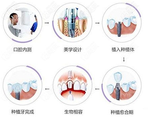 做即刻種植牙的過程