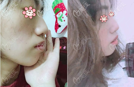 剛開(kāi)始矯正那會(huì)兒 剛開(kāi)始矯正那會(huì)兒