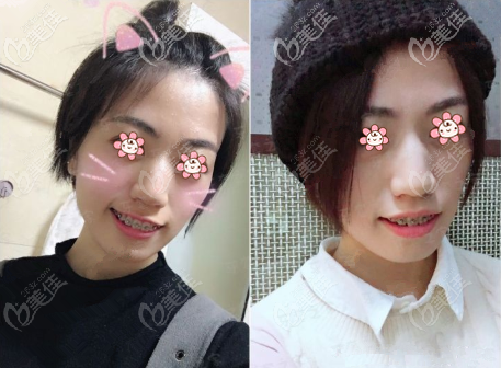 后面感覺(jué)開(kāi)始有效果了 后面感覺(jué)開(kāi)始有效果了