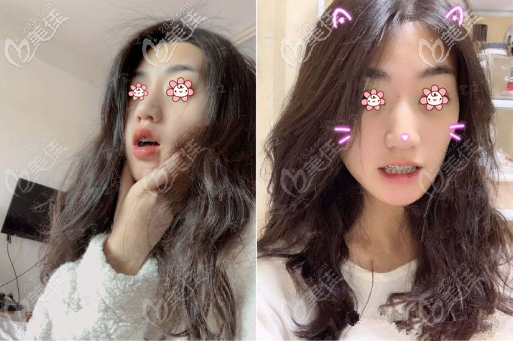 自鎖金屬托槽矯正齙牙2年后照片 自鎖金屬托槽矯正齙牙2年后照片