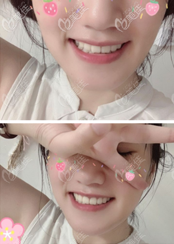 骨性齙牙矯正案例：自鎖金屬托槽和非自鎖區(qū)別挺大，我選了前面