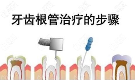 牙齒根管治療步驟示意圖