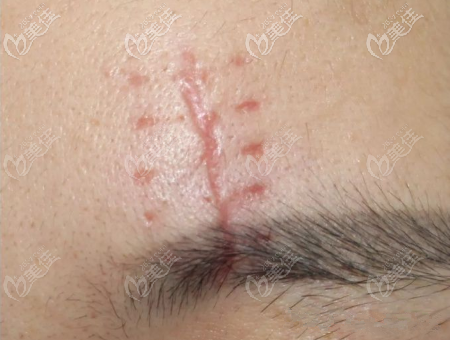 我原來的疤 我原來的疤