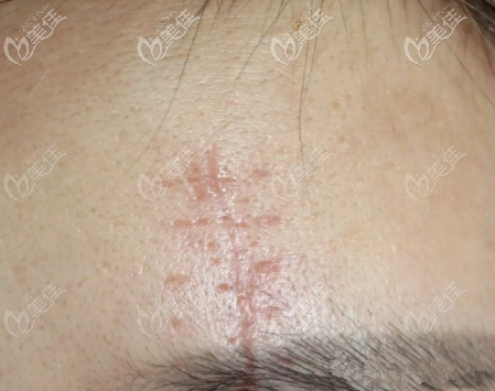 CO2點陣激光祛疤1次后效果 CO2點陣激光祛疤1次后效果