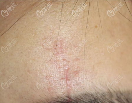 第二次治療后 第二次治療后