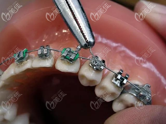金屬托槽矯正 金屬托槽矯正