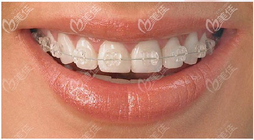 陶瓷半隱形矯正優(yōu)勢圖 陶瓷半隱形矯正優(yōu)勢圖