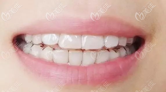 隱形牙套圖示 隱形牙套圖示