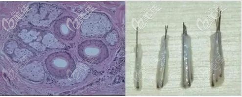 一個毛囊單位含有1到4個毛囊