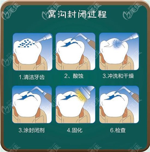 做窩溝封閉的手術(shù)原理