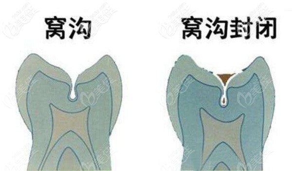 窩溝和做過窩溝封閉的牙齒