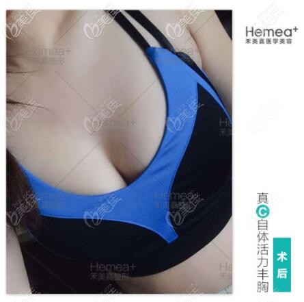 北京禾美嘉任學(xué)會(huì)真C自體活力豐胸真人案例照 北京禾美嘉任學(xué)會(huì)真C自體活力豐胸真人案例照