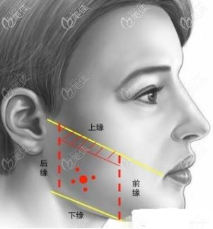 如何判斷自己是咬肌肥大而不是下頜角寬大