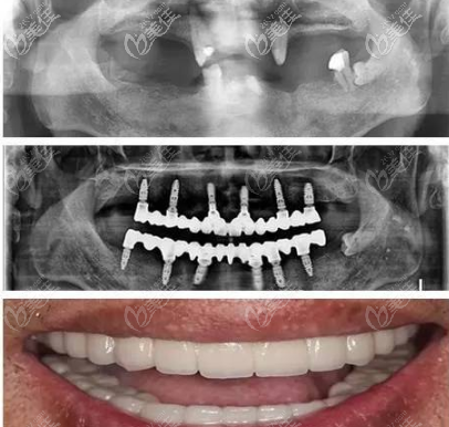 諾貝爾Speedy種植牙齒案例