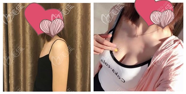 陳毓南醫(yī)生做內(nèi)窺鏡曼托假體隆胸的效果對比圖