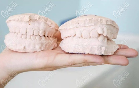 兒童牙齒矯正的牙模前后效果