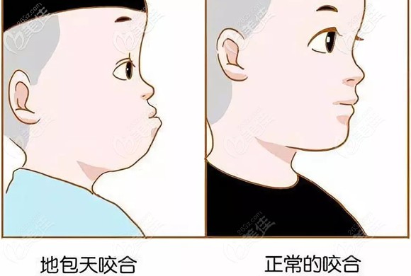 兒童錯牙合面型和正常咬合面型對比圖