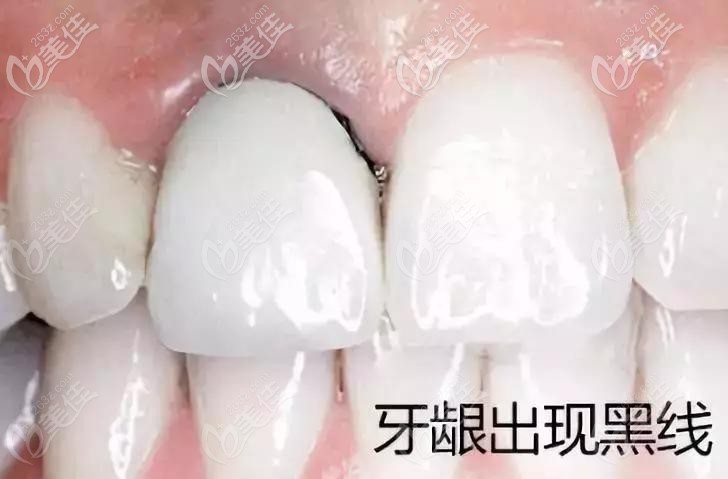 烤瓷牙牙齦發(fā)黑現(xiàn)象