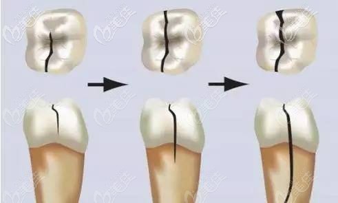 牙齒齲壞的過程