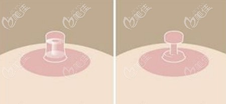 環(huán)形乳頭縮小手術的原理