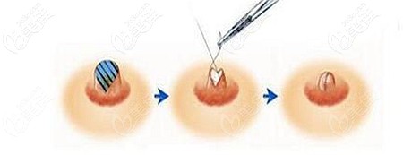 乳頭縮小手術的適應人群