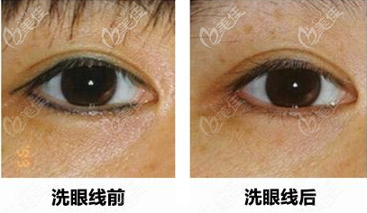 蜂巢皮秒激光去眼線的對比圖