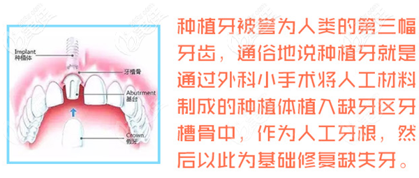 種植牙的優(yōu)勢