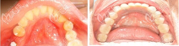 在福州登特口腔做的韓國登騰即刻種植牙當(dāng)天就能使用，效果很滿意