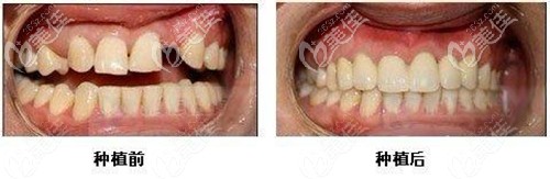 福州登特口腔做韓國登騰即刻種植牙案例