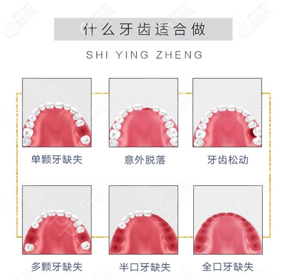 什么牙齒適合做種植牙