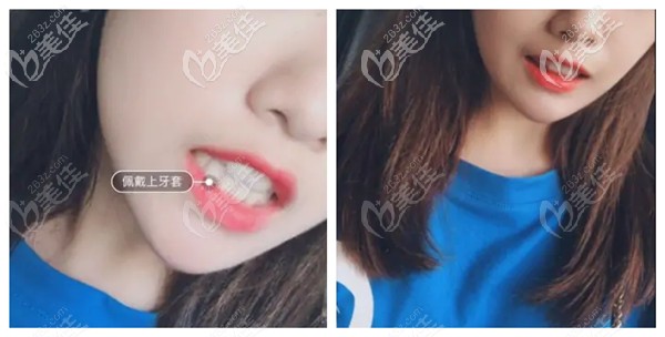 唐山牙博士做隱形牙齒矯正案例