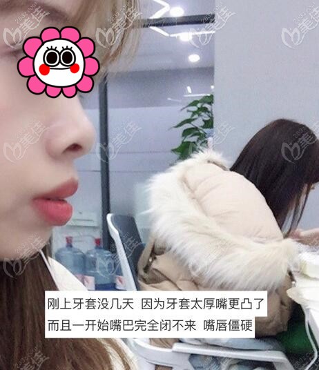 杭州齊爾口腔做金屬自鎖牙套