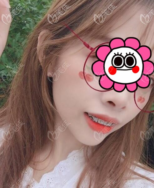 金屬自鎖牙套矯正過程中