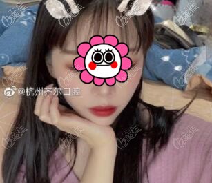 杭州齊爾口腔吳葉群金屬自鎖矯正效果