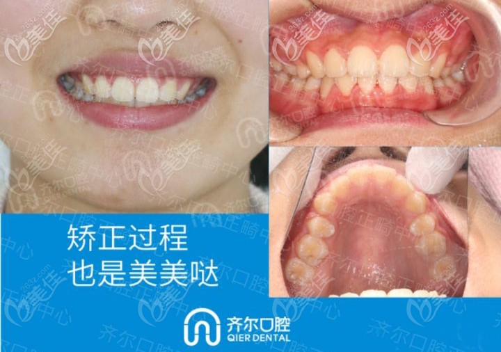 杭州齊爾口腔隱適美矯正案例