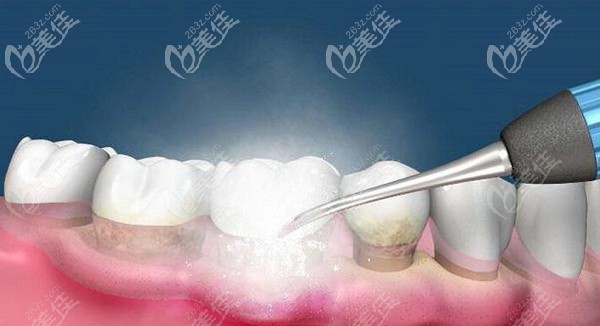 治療牙周病的牙周刮治術(shù)