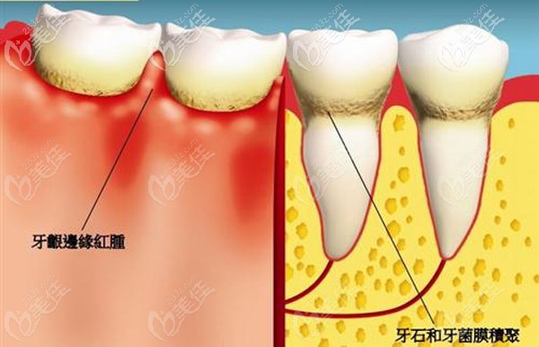 牙周炎的癥狀圖
