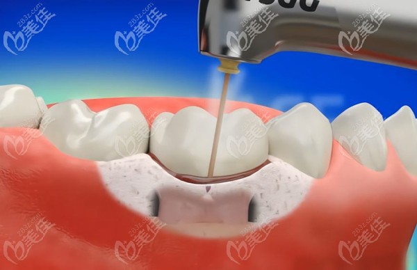 治療牙周病的牙齦翻瓣術(shù)