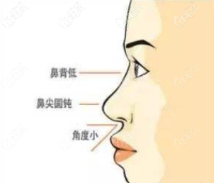 鼻行不佳示意圖 鼻行不佳示意圖