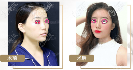 蔣亞楠隆鼻案例 蔣亞楠隆鼻案例