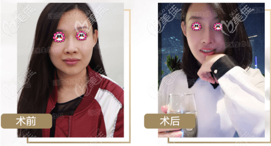 北京俏中關(guān)醫(yī)美膨體鼻綜合案例 北京俏中關(guān)醫(yī)美膨體鼻綜合案例