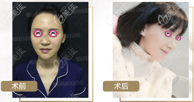 找蔣亞楠做過膨體鼻綜合的顧客表示:醫(yī)生做鼻子技術(shù)還是挺不錯的