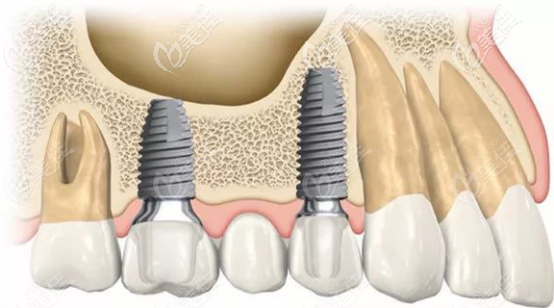 PCC獨(dú)特的錐形設(shè)計(jì)