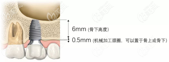 PCC種植體WP5.5mm寬頸平臺(tái)