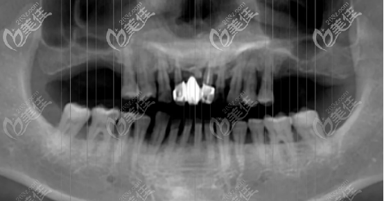 PCC上頜竇提升種植手術(shù)術(shù)前CT檢查