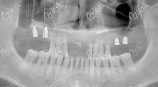 PCC上頜竇提升種植手術(shù)術(shù)后CT片