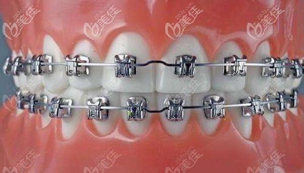 牙齒采用金屬托槽矯正