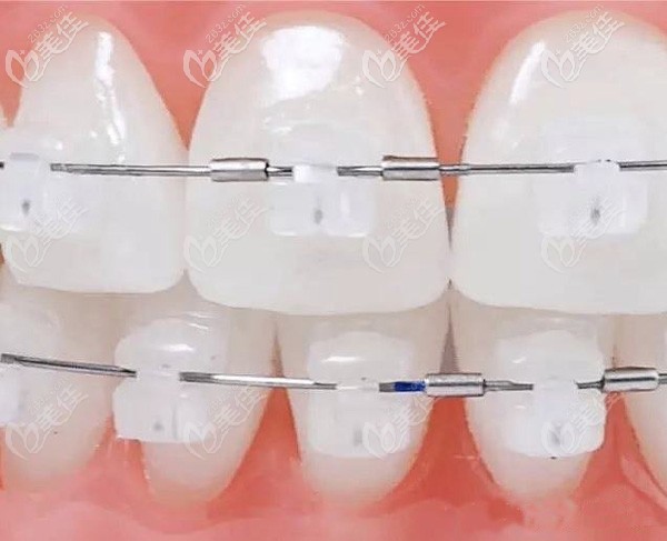 陶瓷半隱形矯正法