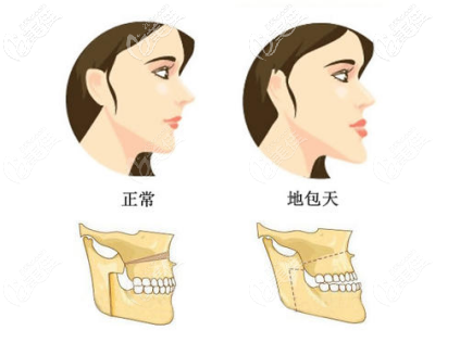 正常頜面和地包天的頜面